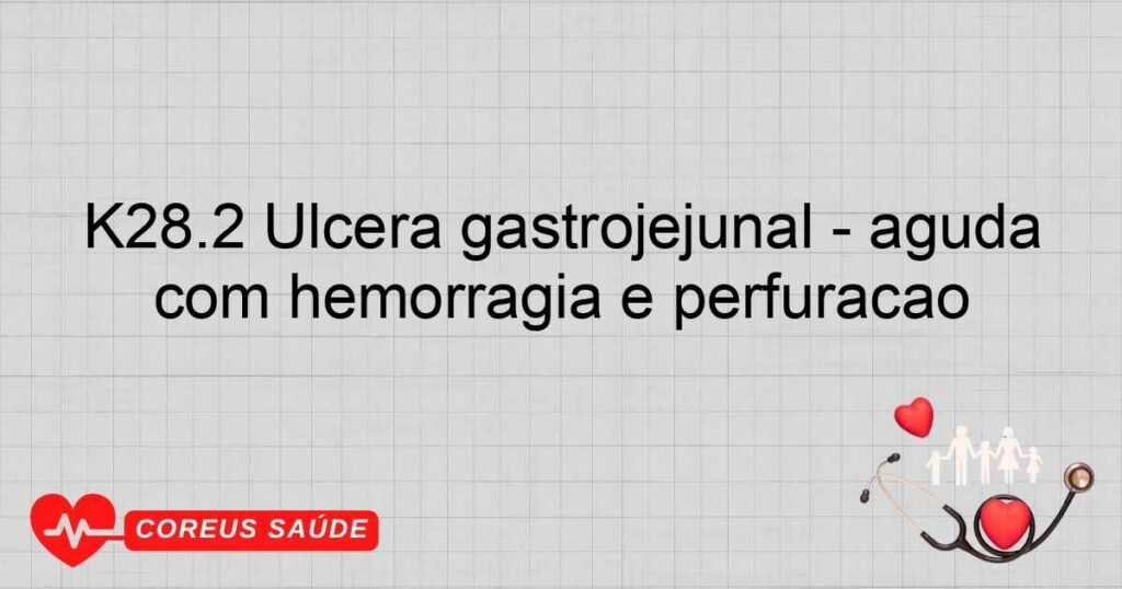 K28.2 Úlcera gastrojejunal ­ aguda com hemorragia e perfuração